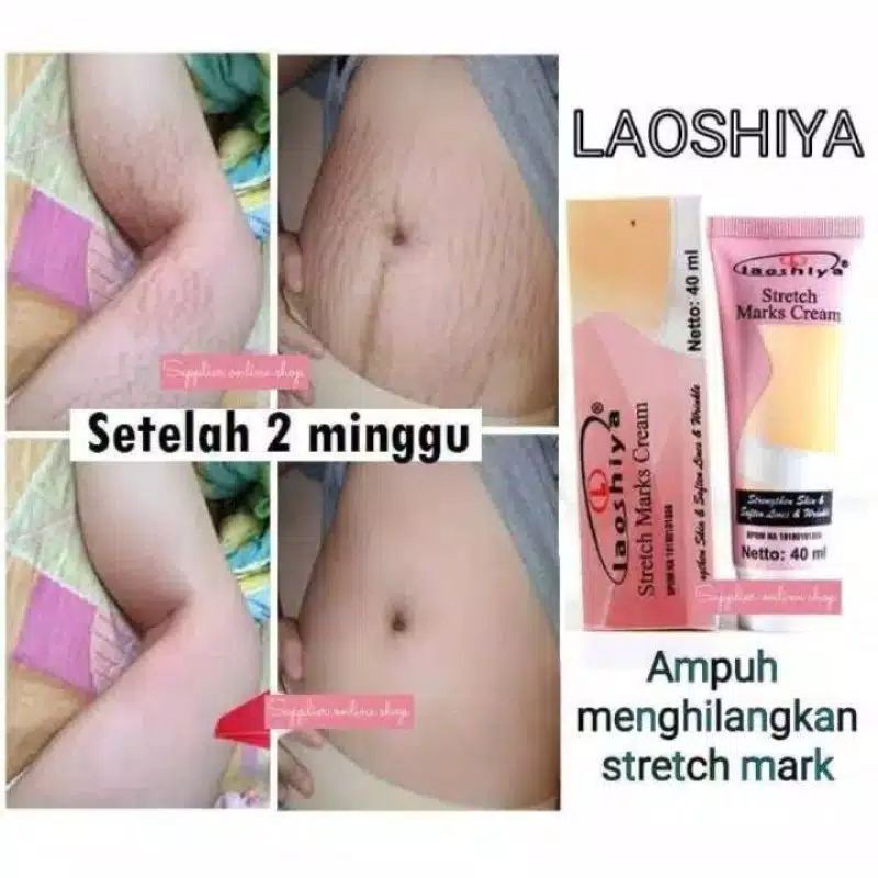 【TERMURAH】 Laoshiya Penghilang Stret...